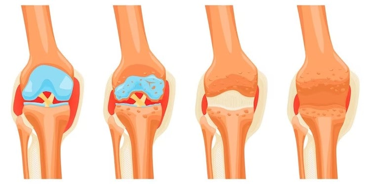 ЛФК при артрозе коленного сустава